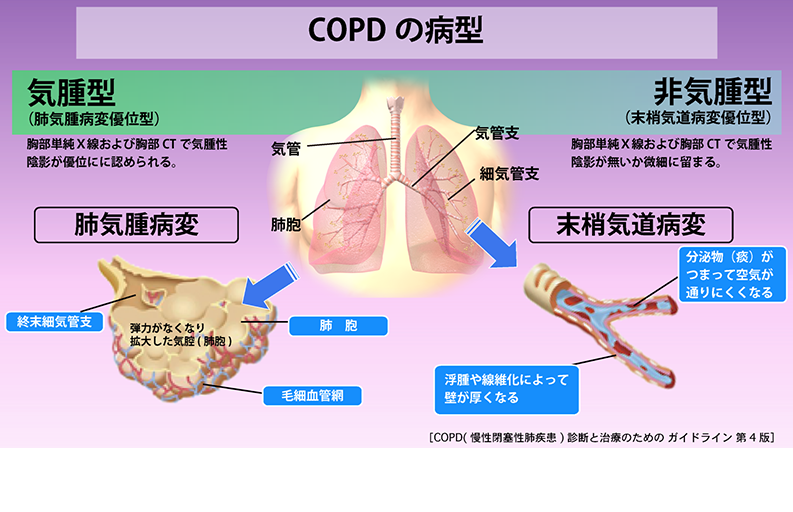 慢性 肺気腫