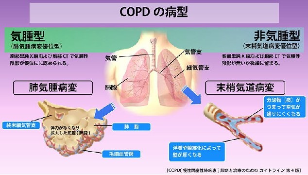 Copd 慢性閉塞性呼吸器疾患