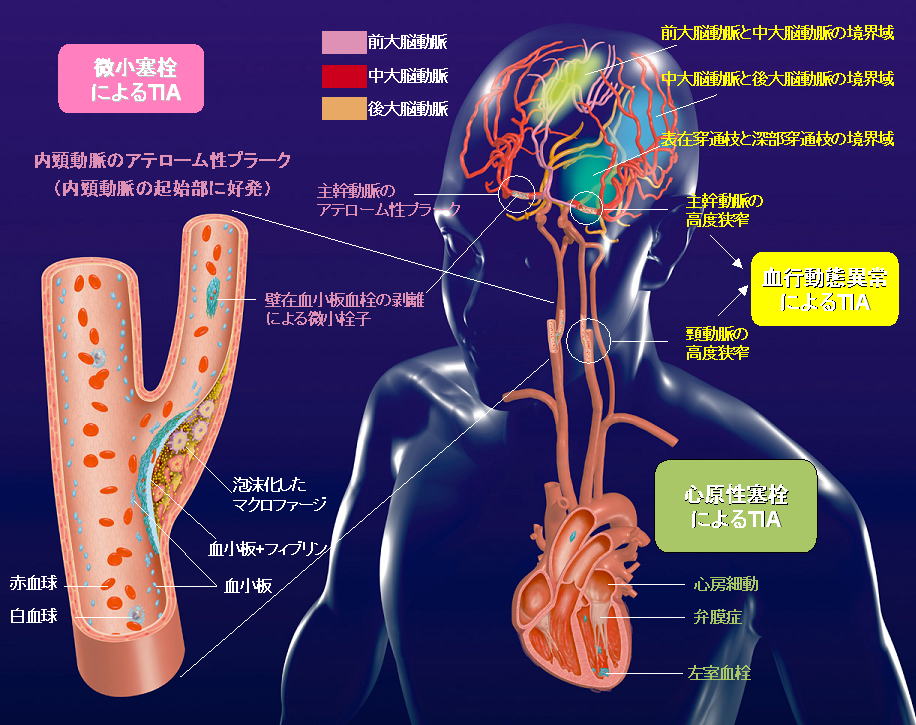 一 過 性 脳 虚 血 発作 入院 しない