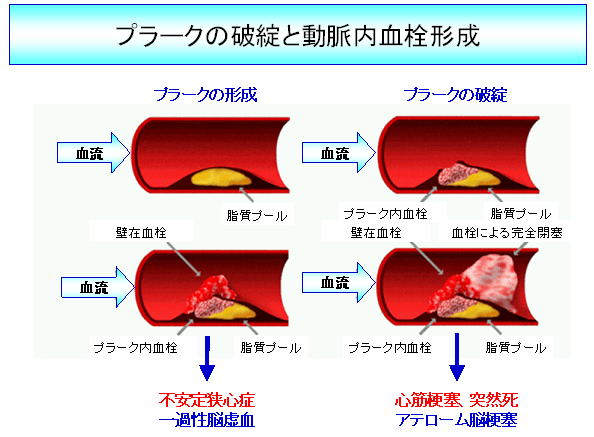 頸 動脈 プラーク と は